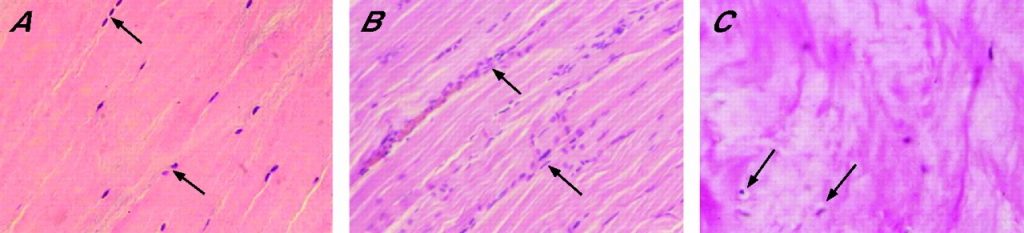 Achilles Tendinopathy