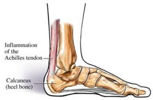 Achilles Tendinopathy