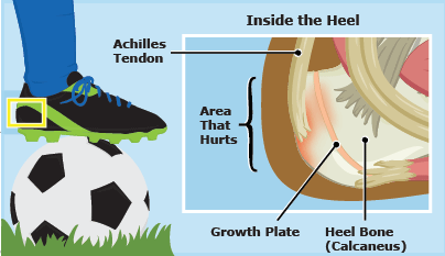 Sever's Disease - Canberra Heel Pain 